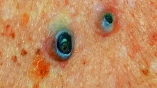 Best Dilated Pore of Winer  Greatest Blackheads [upl. by Hewet]