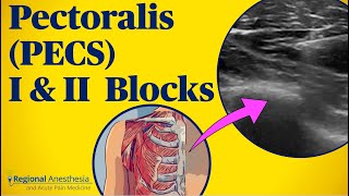 Pectoralis PECS blocks I amp II [upl. by Chaves]