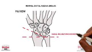 Radiographic features  Normal distal radius angles [upl. by Montana957]