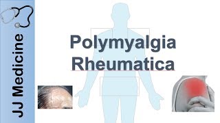 Polymyalgia Rheumatica  Signs amp Symptoms Diagnosis and Treatment [upl. by Darooge]