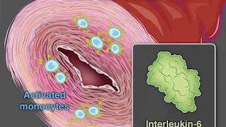 Treating GiantCell Arteritis [upl. by Nennarb]