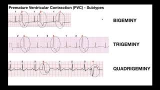 Ventricular Escape Beat ECG  EMTprepcom [upl. by Edas99]