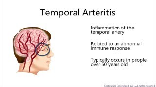 Temporal arteritis [upl. by Yuille]