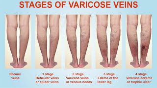 VARICOSE VEINS How To DIAGNOSE amp TREAT Venous Diseases [upl. by Ainitsirc]