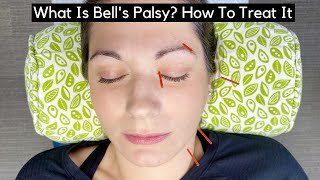 What Is Bells Palsy How To Treat It [upl. by Anailuig]