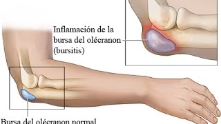 BURSITIS CODO DERRAME ARTICULAR TRATAMIENTO [upl. by Rillings]