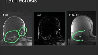 Breast MRI  common findings and cases [upl. by Boyd]