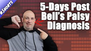 Bells Palsy Recovery Story  5Days Post Diagnosis  Condition Update [upl. by Cedric546]