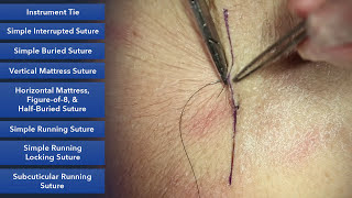 Applying SteriStripsButterfly stitches to a small wound [upl. by Etnasa]