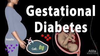 Gestational Diabetes Animation [upl. by Colp]