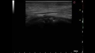 Lateral Patellar Ligament Tear in a Horse [upl. by Adien336]