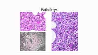 Myelodysplastic Syndrome MDS  What is the Treatment [upl. by Bolten]