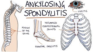 Ankylosing Spondylitis Visual Explanation for Students [upl. by Euton]