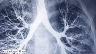 The Stages of Mesothelioma  An Overview [upl. by Braasch]