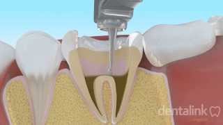 Endodoncia completa PASO A PASO  Video 3D [upl. by Fishbein953]