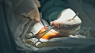 Treating Varicose Veins  SLUCare Vascular Surgery [upl. by Hyrup]