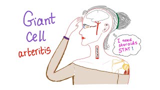 Giant cell arteritis Temporal arteritis [upl. by Ciryl]