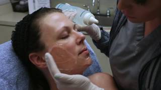 How does the IPL Photofacial work Watch and learn  Seiler Skin [upl. by Yrneh]