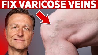 Varicose Veins What are They and How are They Treated [upl. by Kerge]