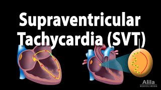 Supraventricular Tachycardia SVT PSVT Animation [upl. by Danny643]