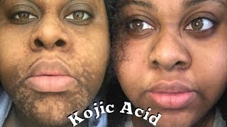 4 MONTHS KOJIC ACID EXPERIENCE \\ Sherelle Saint Rose [upl. by Wales]