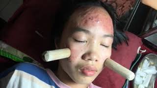 Introduction about inflammatory acne and how to solve it PART 1  official video  742019 [upl. by Ulysses466]