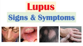 Must Know Symptoms of Mold Exposure [upl. by Kristian131]