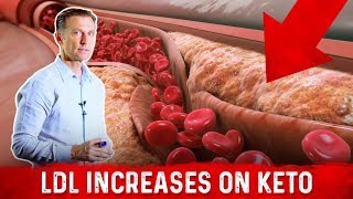 Cardiologist Dr Nadir Ali Explains LDL Bad Cholesterol Spike With Keto – DrBerg [upl. by Ambrogio782]