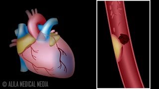 How deep vein thrombosis DVT forms  Bupa Health [upl. by Enayr]