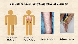 Vasculitis  An Overview [upl. by Engleman494]