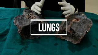 Lungs  gross anatomy [upl. by Eniloj]