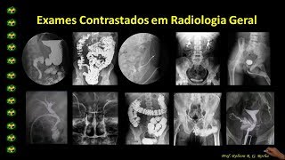 Exames Contrastados  Urografia Excretora aula 1 [upl. by Emia]