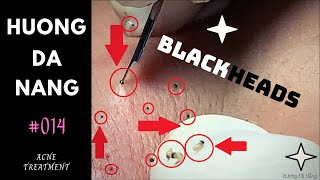 014  Lots of surprising BLACKHEADS  Hương Đà Nẵng  akne Behandlung [upl. by Atikihs101]