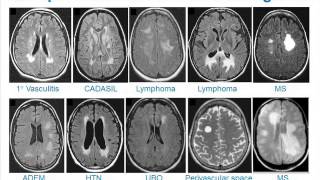 MRI Uses in MS [upl. by Dragelin569]