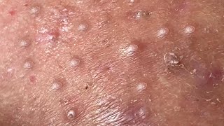 Huong Da Nang Acne Treatment 274  Mr Thanh Part 2 [upl. by Sevein736]